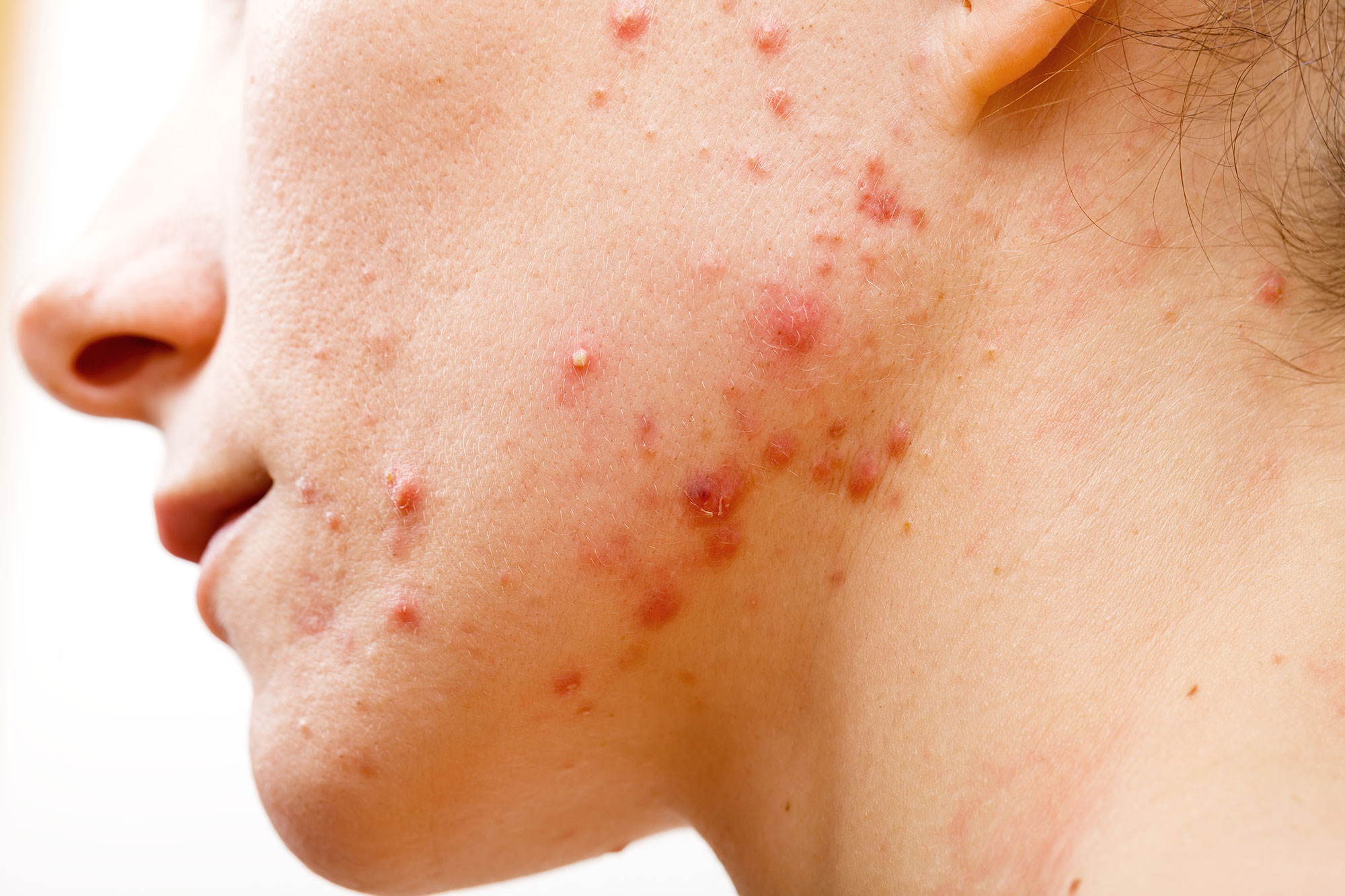 acne-huidprobleem